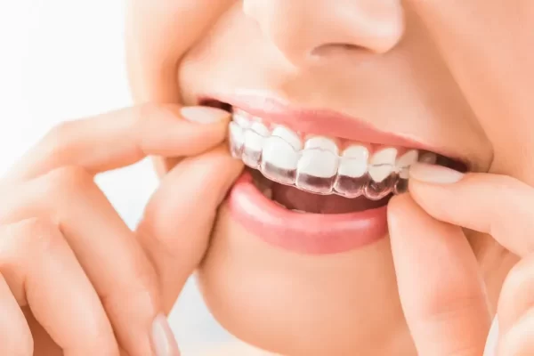Invisalign Ryde