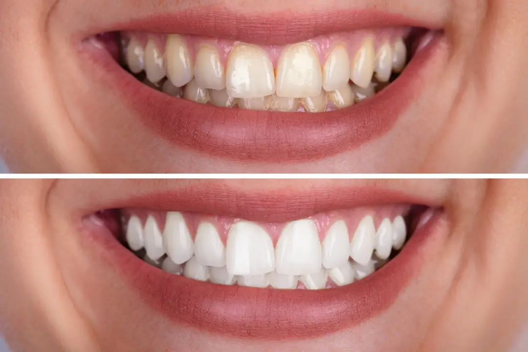 Teeth Whitening Putney