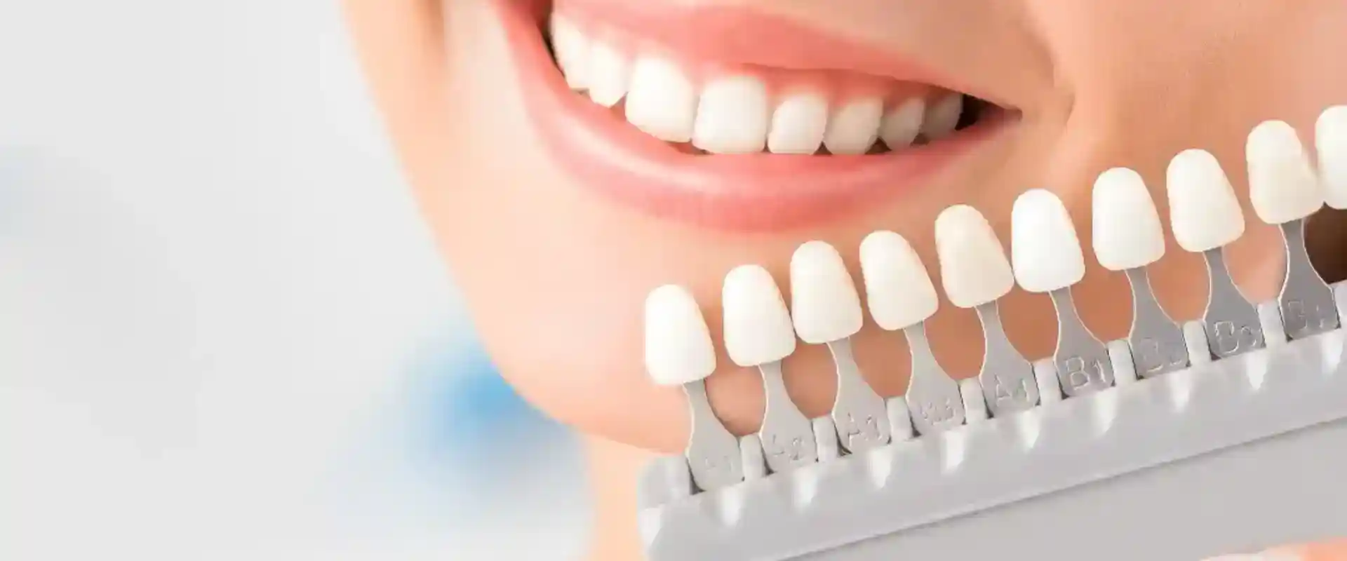 Teeth Whitening Putney